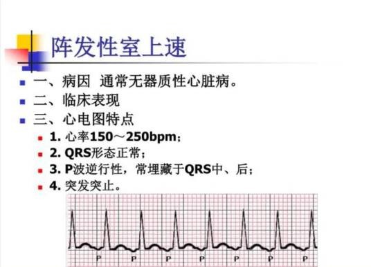 阵发性室上性心动过速