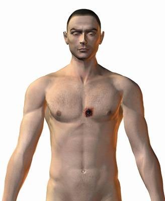 枪伤