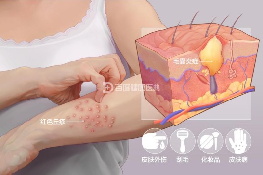 毛囊炎