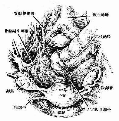 子宫积液