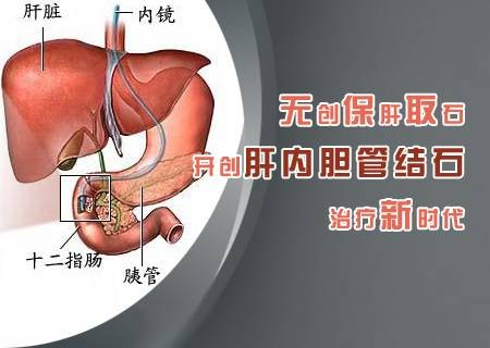 无创保肝取石术