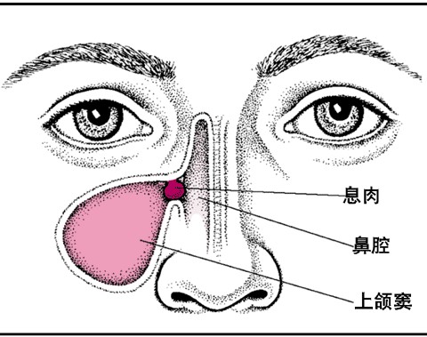 鼻额窦炎