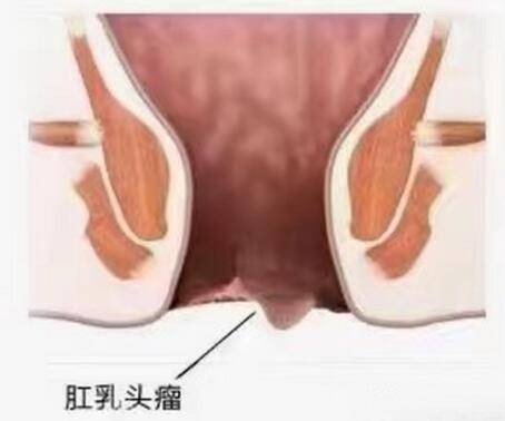肛乳头瘤