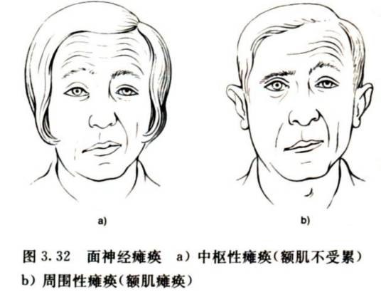 中枢性瘫痪