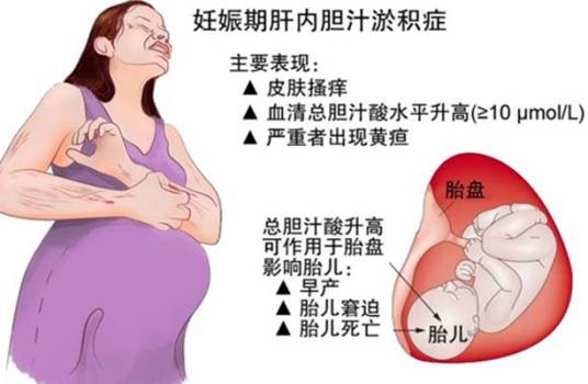 胆汁淤积