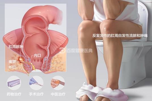 肛瘘