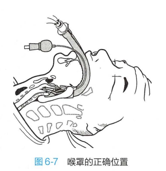 喉罩
