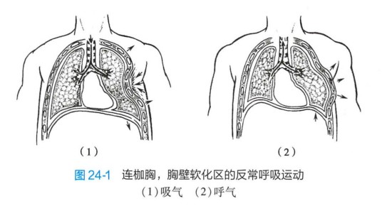 连枷胸