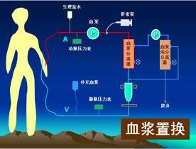 血浆置换治疗系统性红斑狼疮