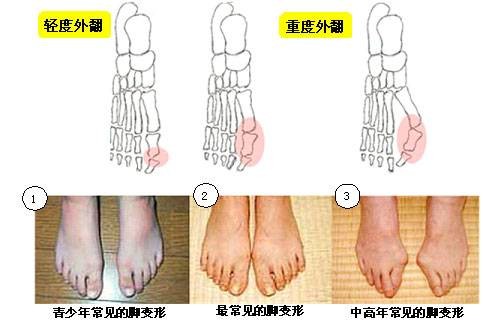 大拇指外翻