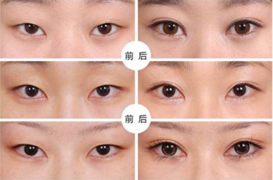 眼尾提升术