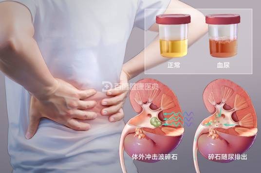 肾结石