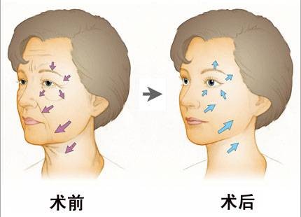 除皱针