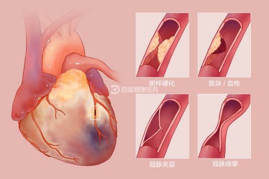 急性心肌梗死（病症）