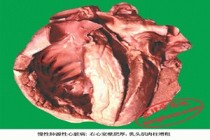 急性肺心病