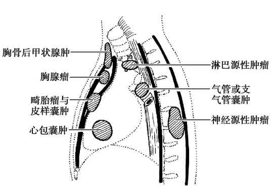 纵隔肿瘤