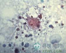 虱传斑疹伤寒