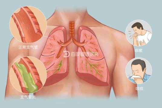 支气管炎
