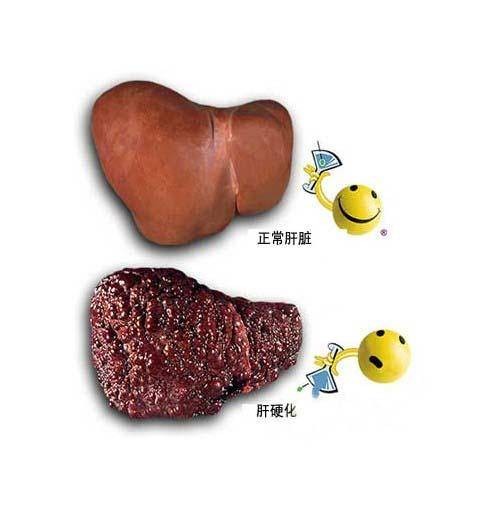 肝炎后肝硬化