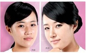 歪鼻整复术