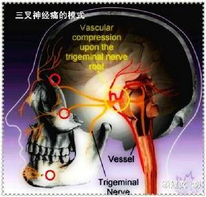 痛性痉挛