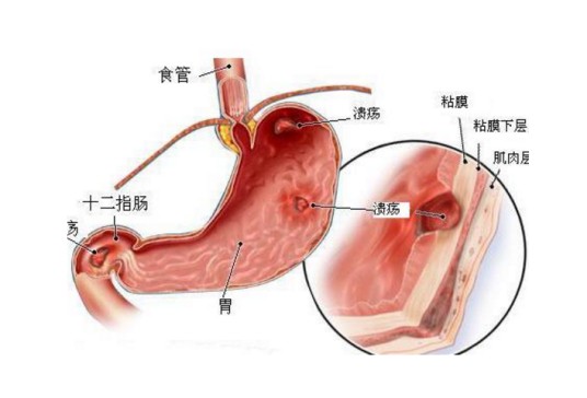 胃溃疡恶变