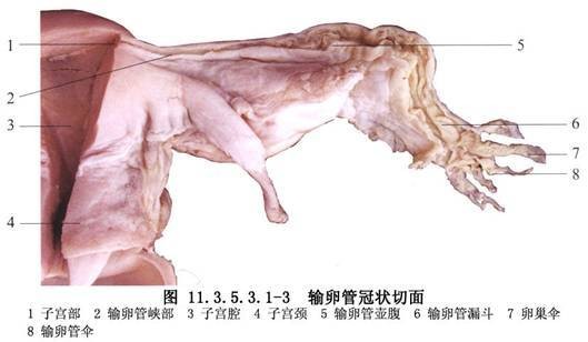 输卵管峡部阻塞