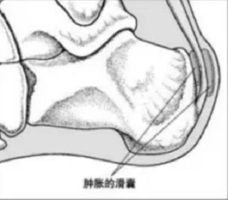 跟骨滑囊炎