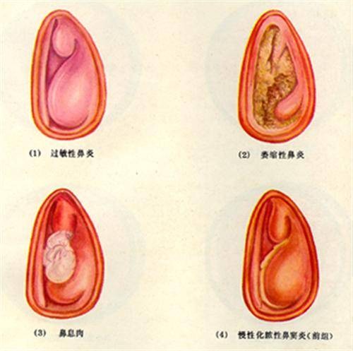 交替性鼻塞
