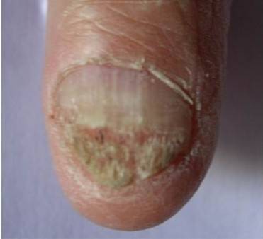 慢性甲沟炎型灰指甲