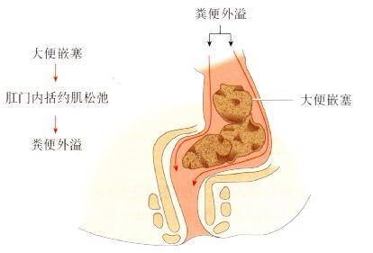儿童大便失禁