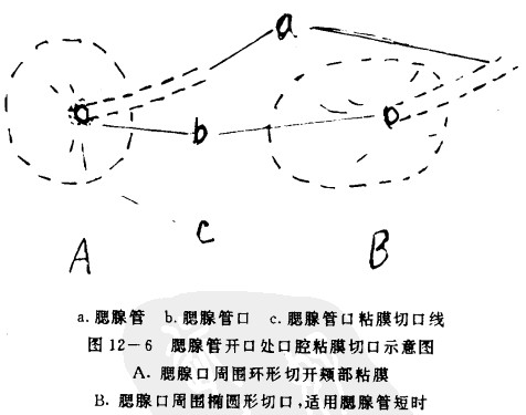 干眼病手术