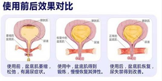 盆底肌肉康复