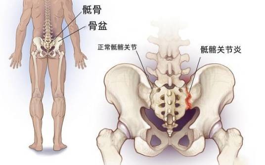 骶髂关节炎