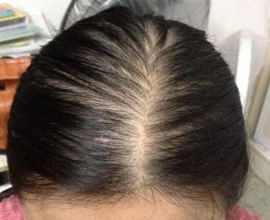 油腻性脱发