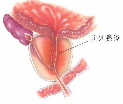 真菌性前列腺炎