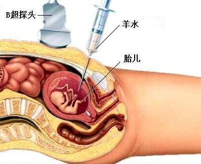 羊水穿刺检查