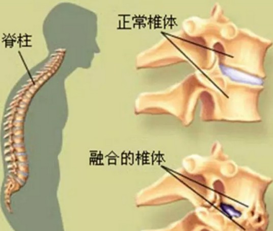 强直性脊柱炎治疗网