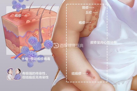 水痘