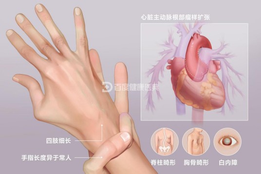 马方综合征