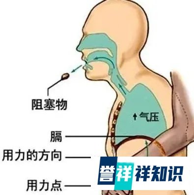 健康科普 | 必学！拯救百万人“生命拥抱”的海姆立克急救法