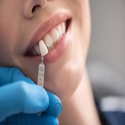 四环素牙治疗费用多少