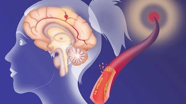 脑炎后遗症怎么引起的