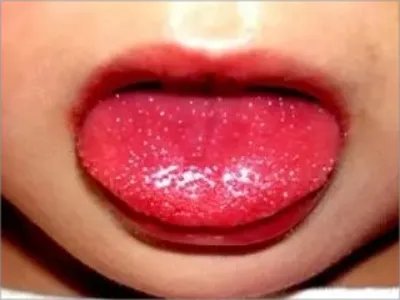 急性发热性皮肤黏膜淋巴结综合征充血图片