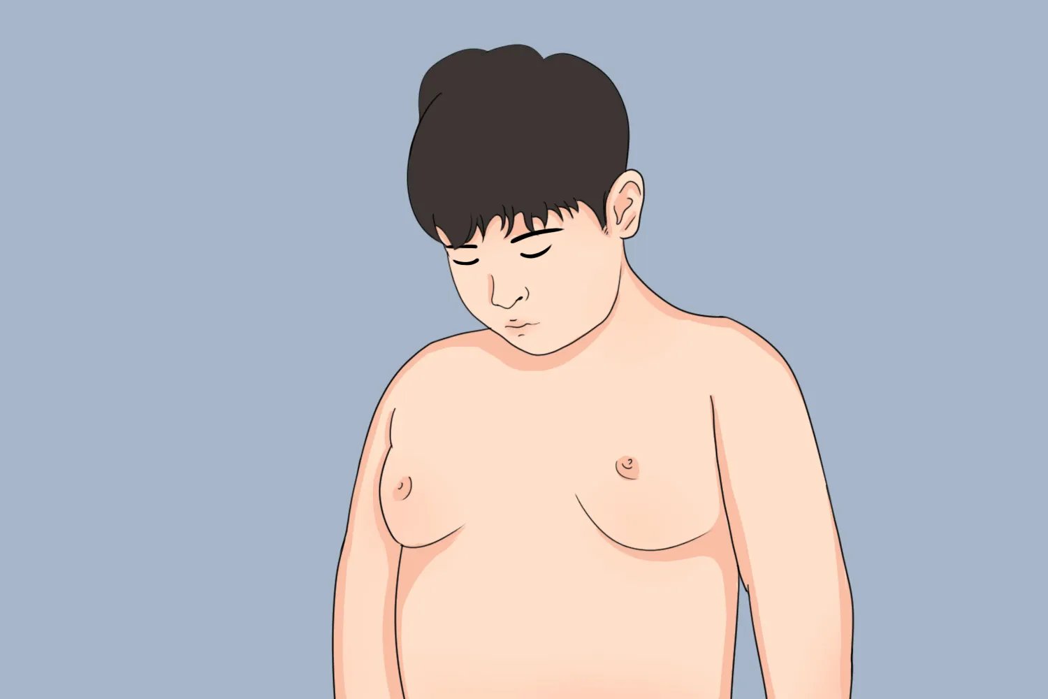 克莱里菲尔特综合征图片