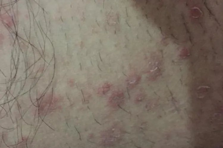 睾丸旁边大腿内侧红斑图片