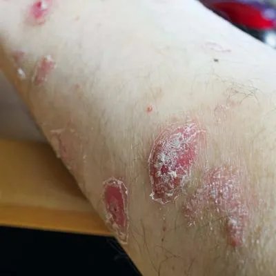 体癣有效的治疗方法有哪些