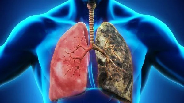 何氏肺痨方治疗肺结核效果如何？肺结核患者应该注意劳逸结合
