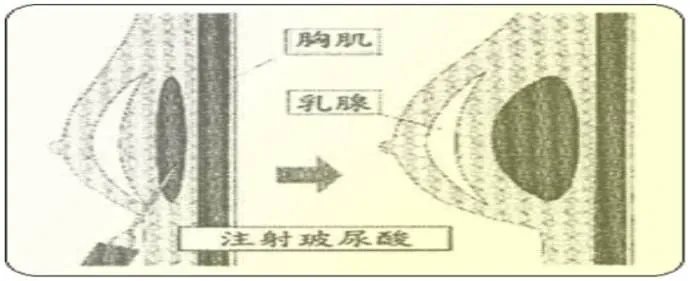 玻尿酸注射隆胸要注意什么？