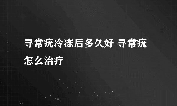寻常疣冷冻后多久好 寻常疣怎么治疗